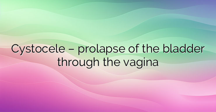 Cystocele – prolapse of the bladder through the vagina